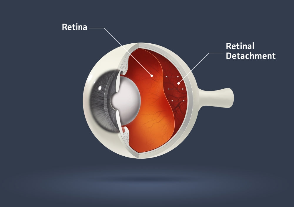 Why Does Myopia Cause Retinal Detachment?